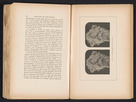 Two macro-uptakes of tuberculosis in the larynx, Dr. Garel, c. 1891 - in or before 1901 Canvas Print