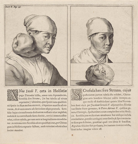 Anneke Jacobs van Thetenbul before and after surgery of a tumor, Cornelis Visscher (II), 1693 Canvas Print